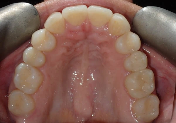 After image